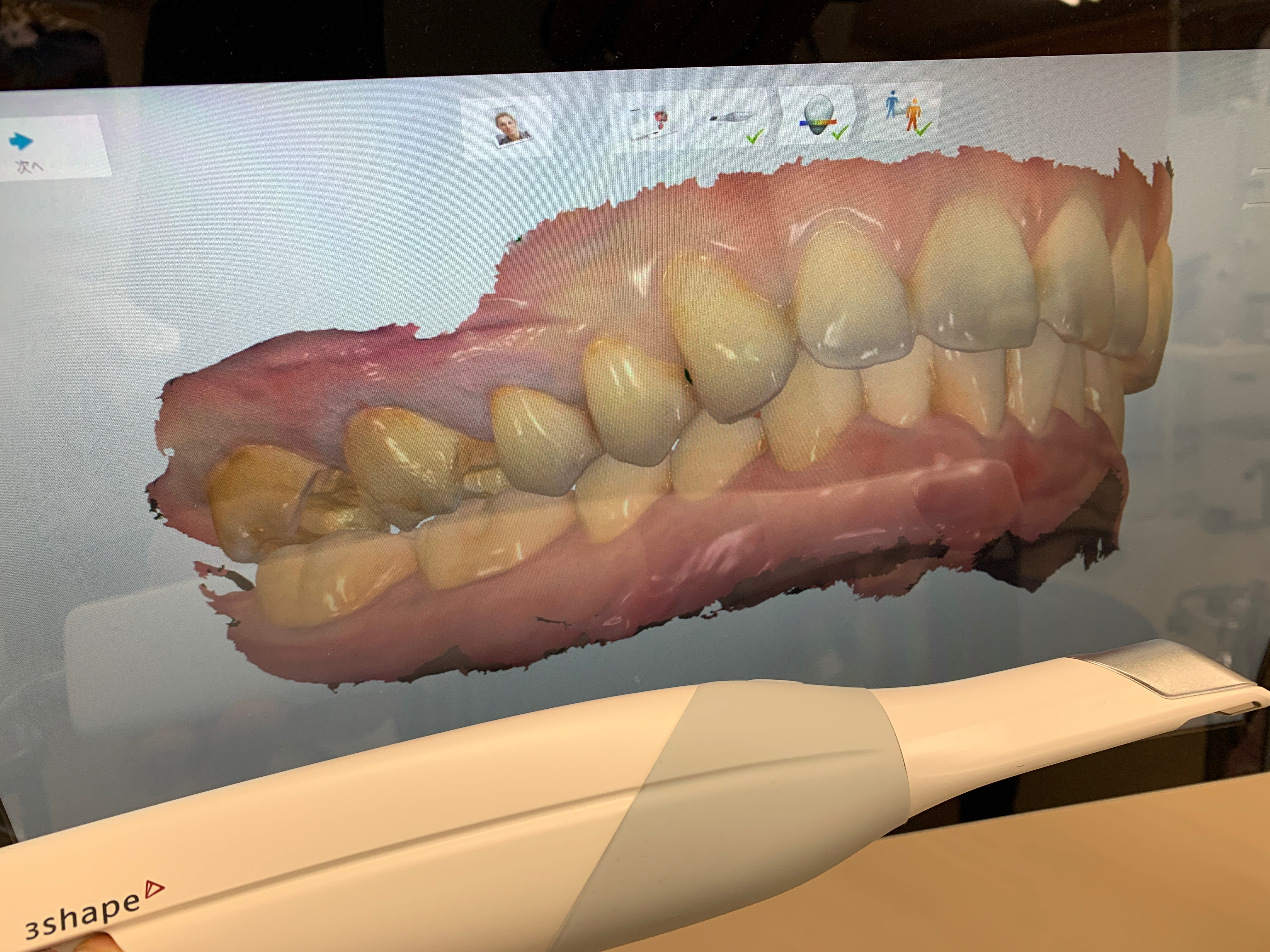 口腔内スキャナー✨