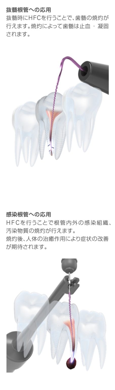 根の治療の新しい装置(ROOT ZX3+高周波モジュール)導入しました。